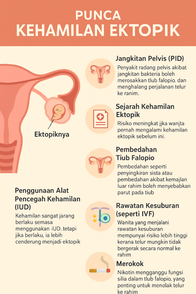 kehamilan ektopik