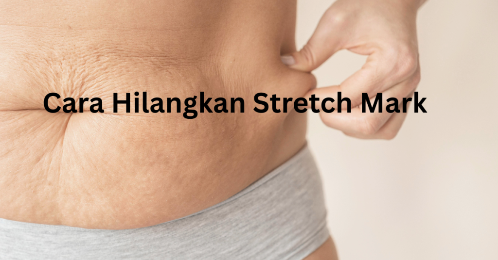 Sakit Mata Tengok Tanda Regangan Pada Perut? Ibu, Ini Cara Hilangkan Stretch Mark Yang Berkesan!