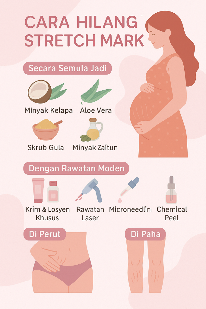 cara hilangkan stretch mark 